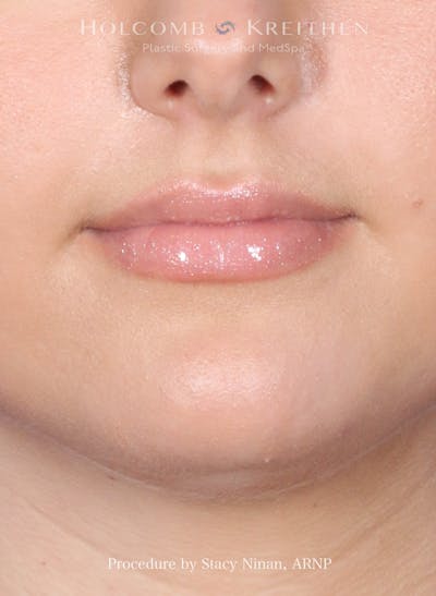 Filler Before & After Gallery - Patient 357406 - Image 1
