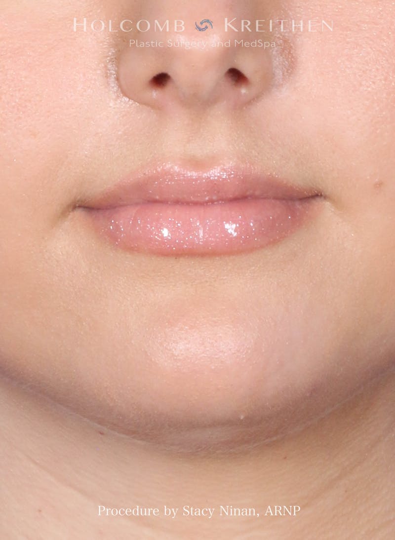 Filler Before & After Gallery - Patient 357406 - Image 1