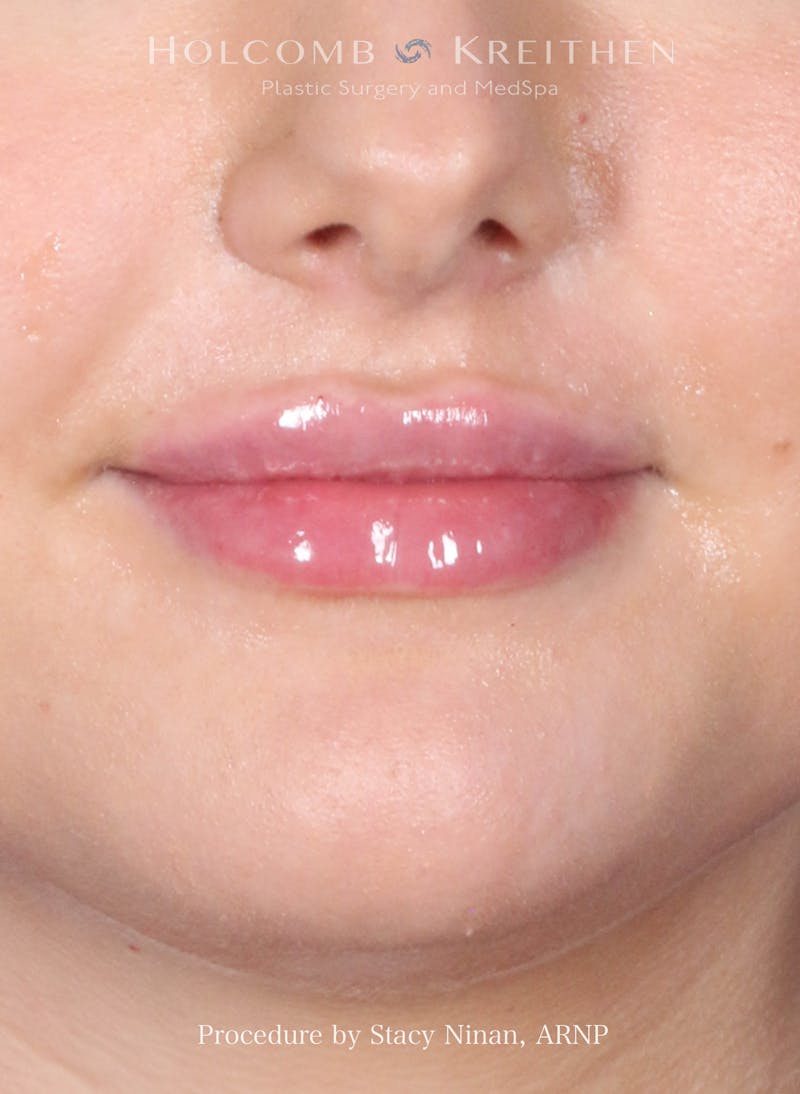 Filler Before & After Gallery - Patient 357406 - Image 2
