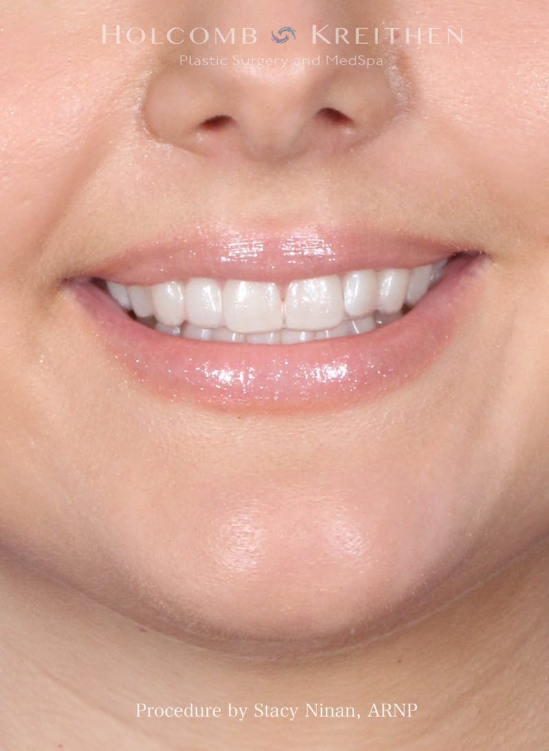 Filler Before & After Gallery - Patient 357406 - Image 3
