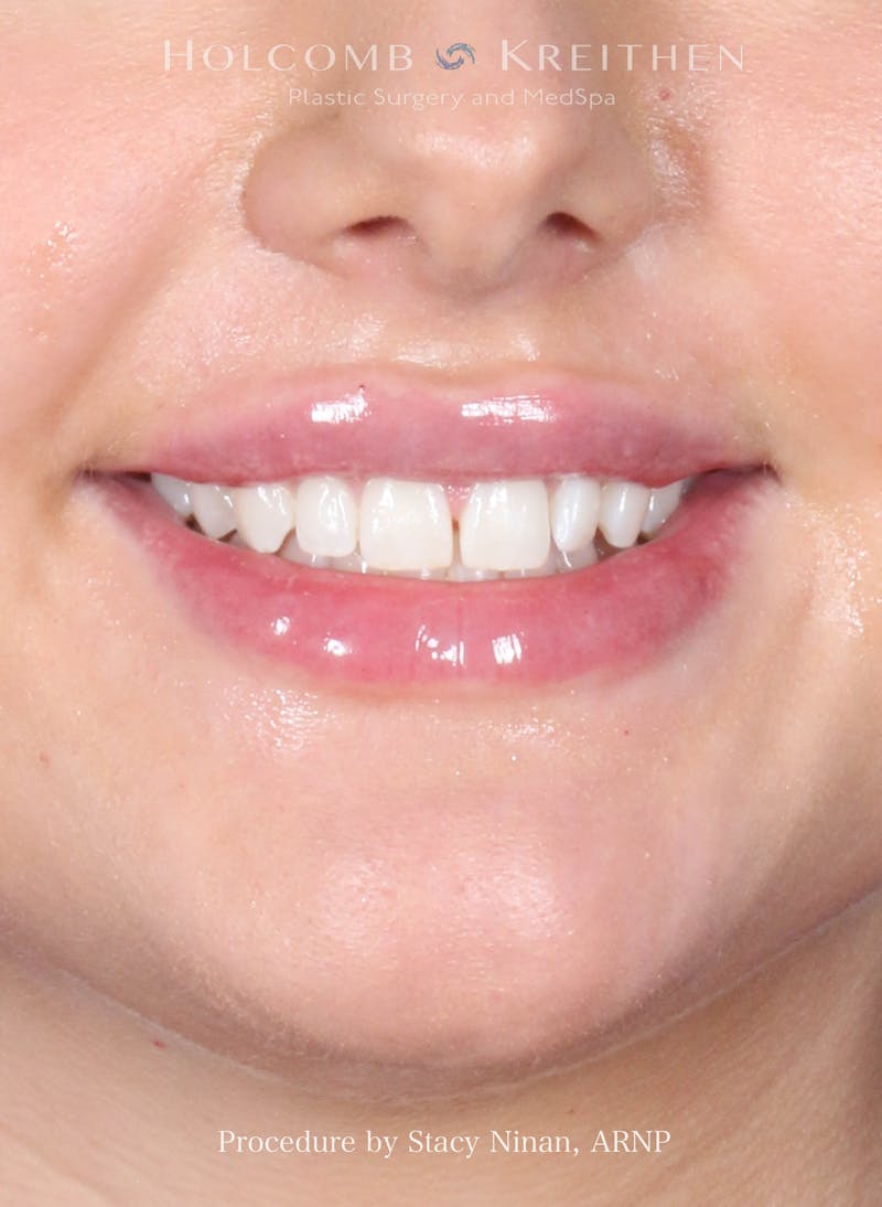 Filler Before & After Gallery - Patient 357406 - Image 4