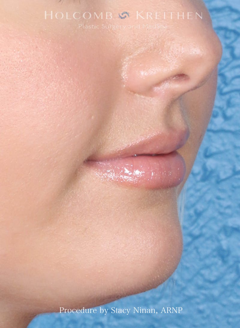 Filler Before & After Gallery - Patient 357406 - Image 5