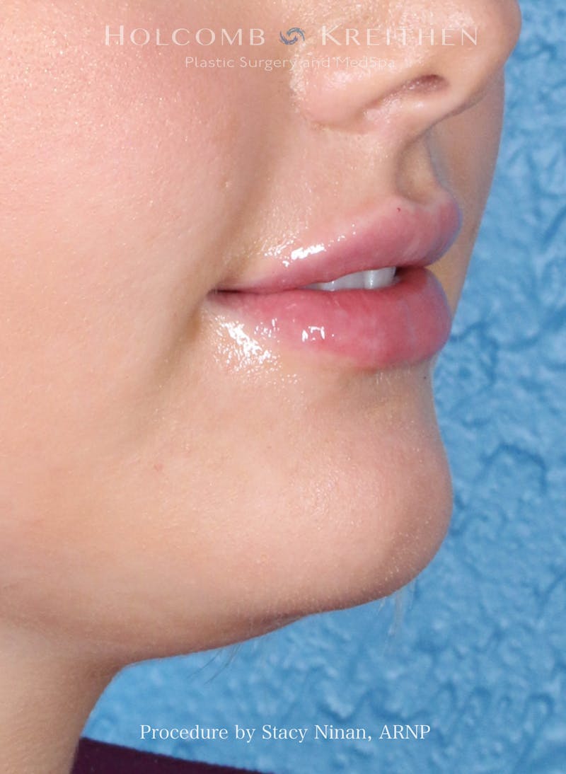 Filler Before & After Gallery - Patient 357406 - Image 6