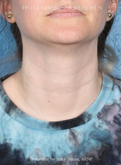 Filler Before & After Gallery - Patient 349478 - Image 1