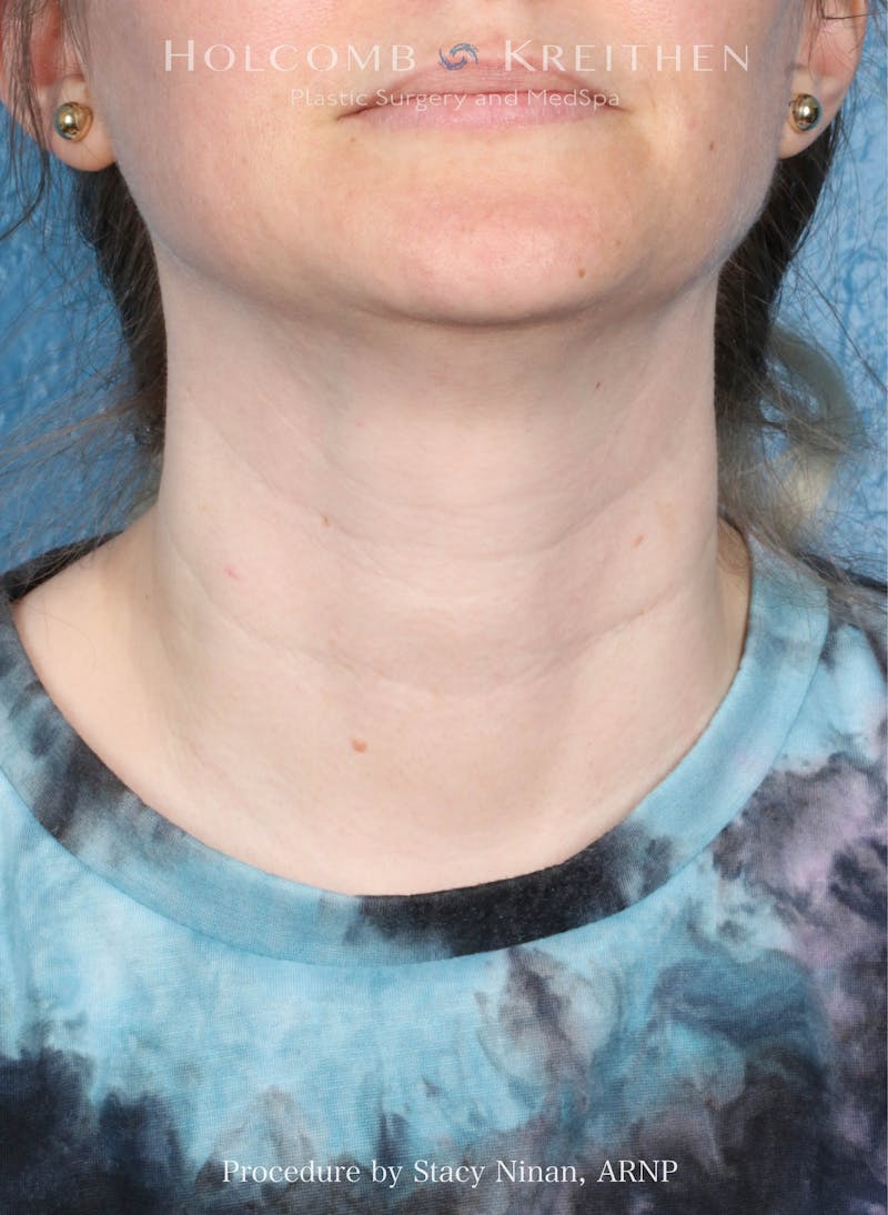 Filler Before & After Gallery - Patient 349478 - Image 1