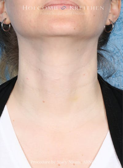 Filler Before & After Gallery - Patient 349478 - Image 2
