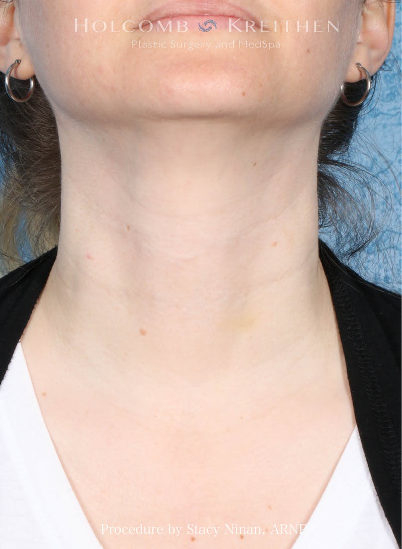 Filler Before & After Gallery - Patient 349478 - Image 2