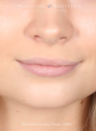 Filler Before & After Gallery - Patient 344909 - Image 1