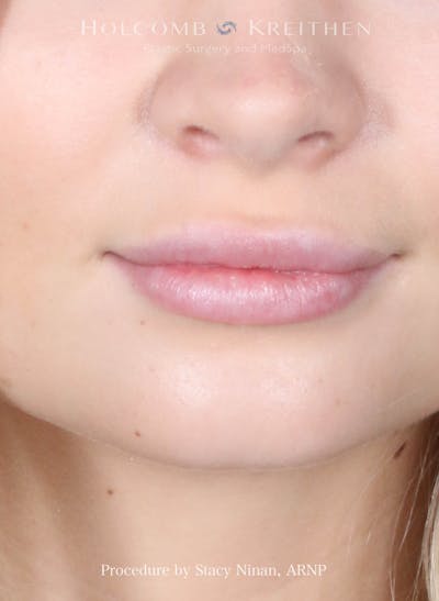 Filler Before & After Gallery - Patient 344909 - Image 2