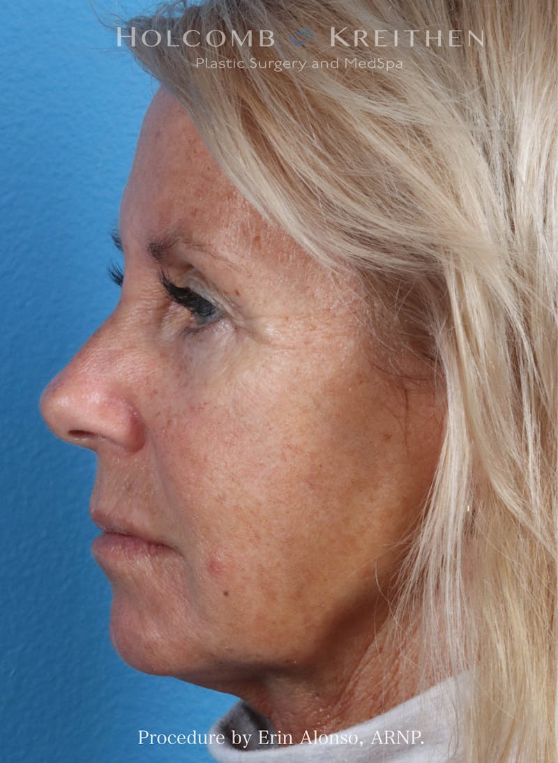 Filler Before & After Gallery - Patient 116236 - Image 1