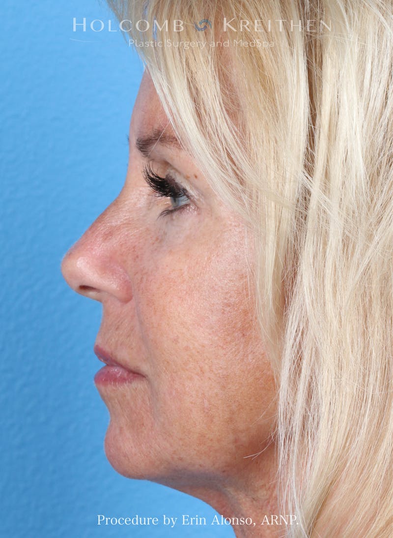 Filler Before & After Gallery - Patient 116236 - Image 2