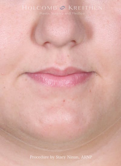 Filler Before & After Gallery - Patient 402931 - Image 1