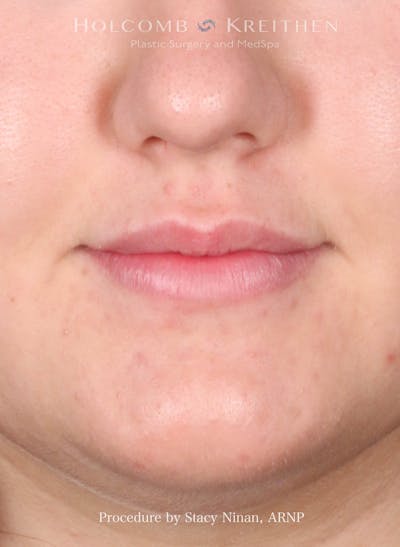 Filler Before & After Gallery - Patient 402931 - Image 2
