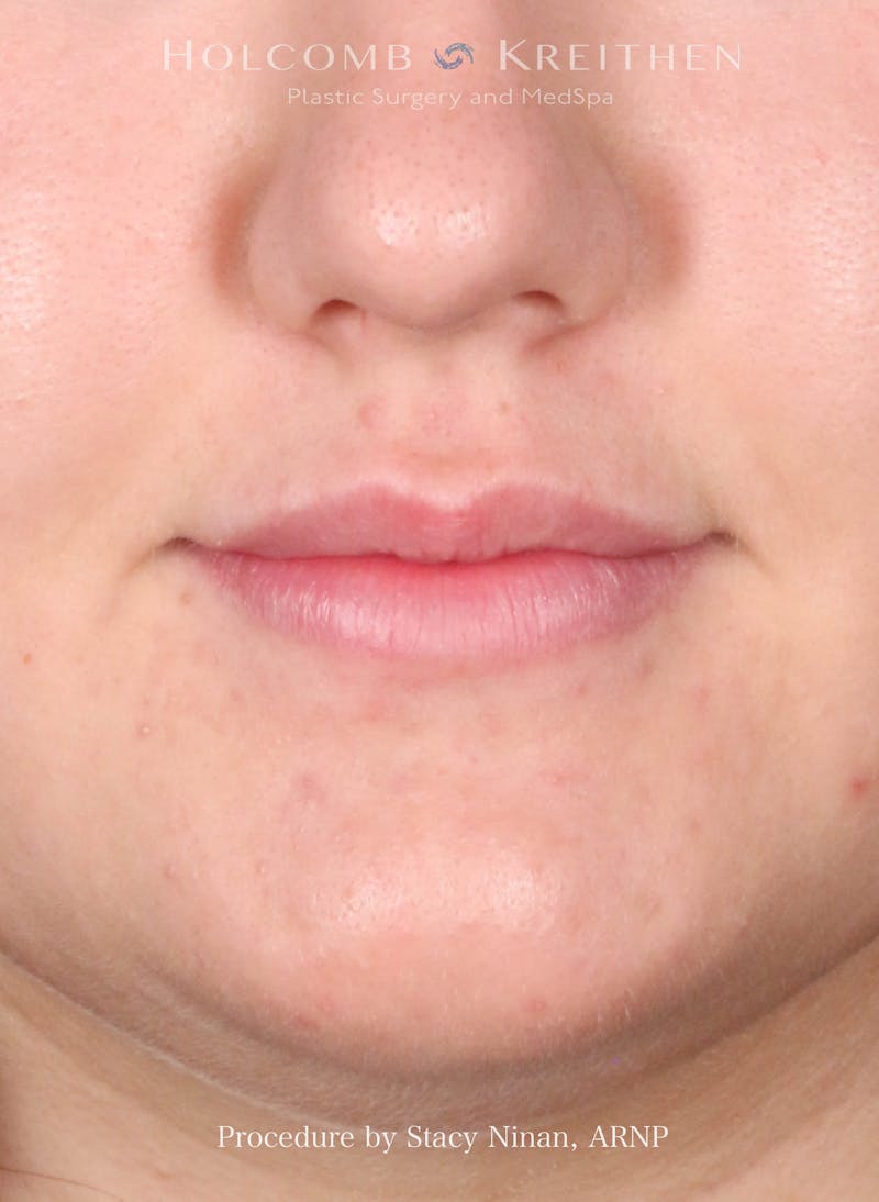 Filler Before & After Gallery - Patient 402931 - Image 2