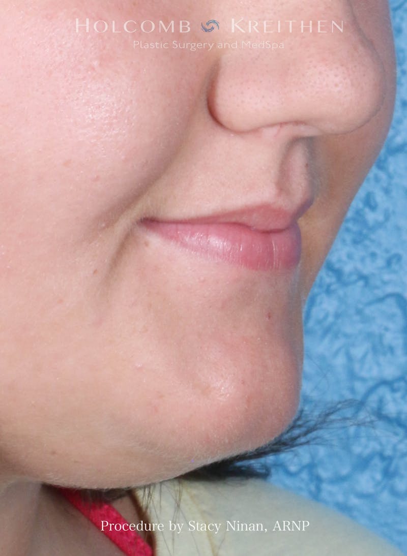 Filler Before & After Gallery - Patient 402931 - Image 3