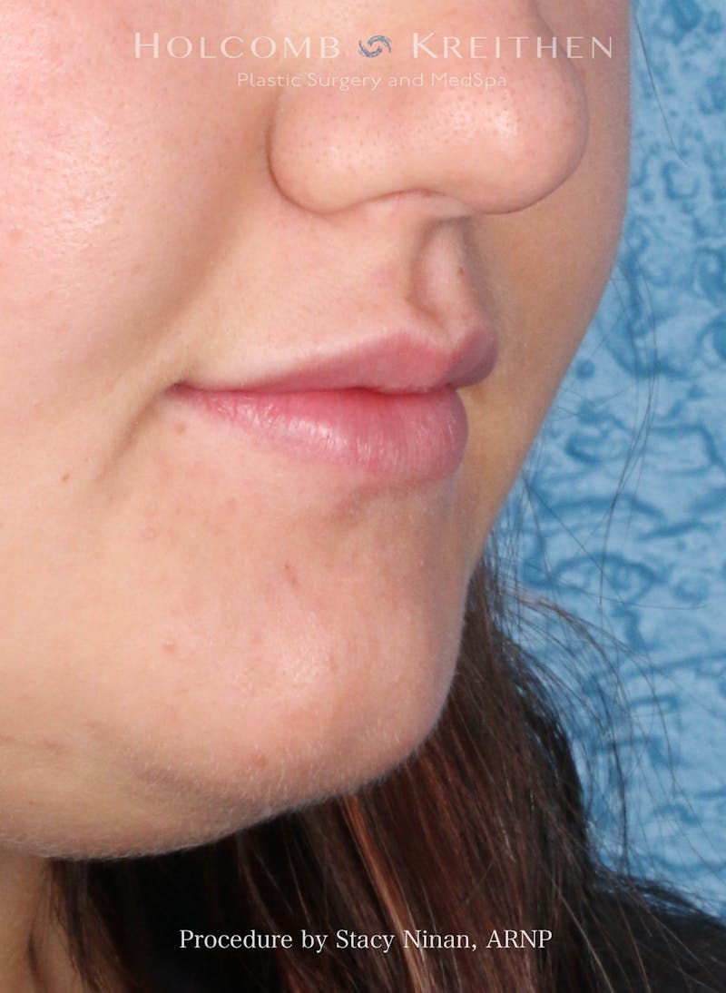 Filler Before & After Gallery - Patient 402931 - Image 4