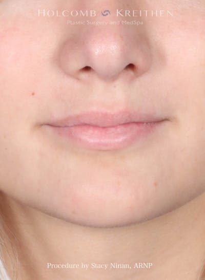 Filler Before & After Gallery - Patient 427260 - Image 1