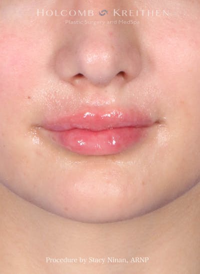 Filler Before & After Gallery - Patient 427260 - Image 2
