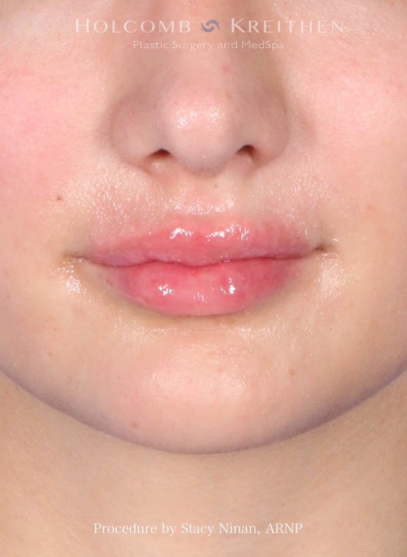 Filler Before & After Gallery - Patient 427260 - Image 2
