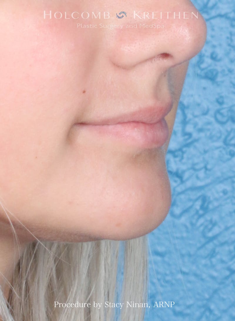 Filler Before & After Gallery - Patient 427260 - Image 3