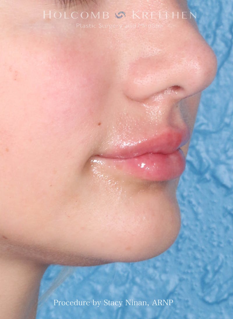Filler Before & After Gallery - Patient 427260 - Image 4