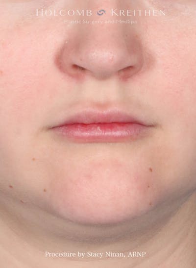 Filler Before & After Gallery - Patient 171579 - Image 1