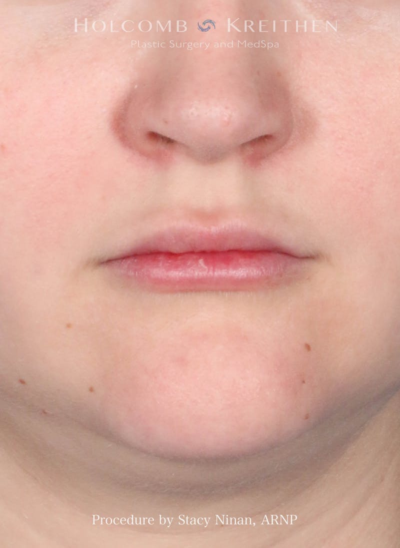 Filler Before & After Gallery - Patient 171579 - Image 1