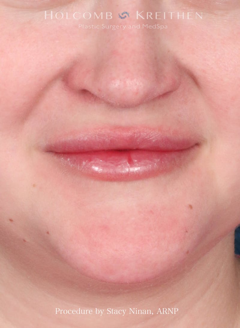 Filler Before & After Gallery - Patient 171579 - Image 2