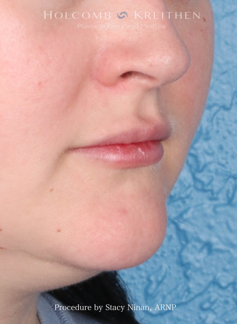 Filler Before & After Gallery - Patient 171579 - Image 3