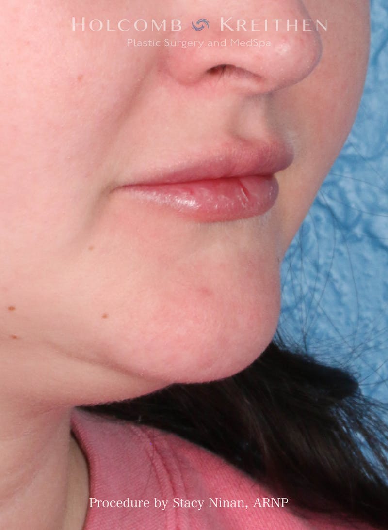 Filler Before & After Gallery - Patient 171579 - Image 4