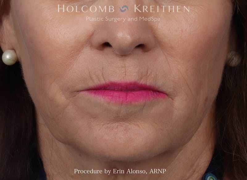 Morpheus  Before & After Gallery - Patient 619845 - Image 1