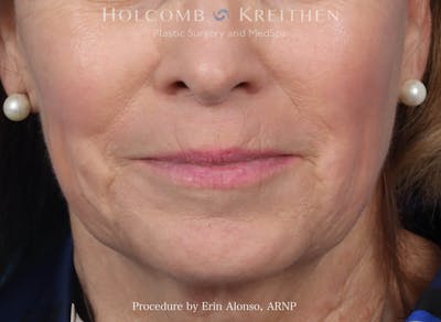 Morpheus  Before & After Gallery - Patient 619845 - Image 2