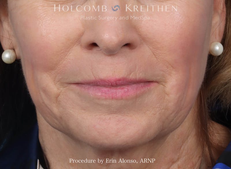 Morpheus  Before & After Gallery - Patient 619845 - Image 2