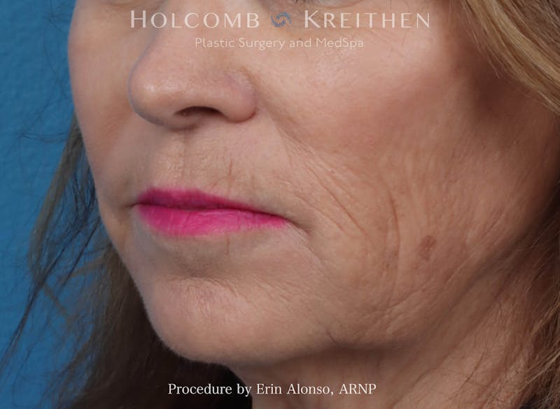 Morpheus  Before & After Gallery - Patient 619845 - Image 3