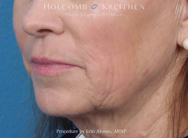 Morpheus  Before & After Gallery - Patient 619845 - Image 4