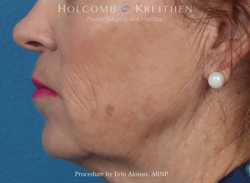 Morpheus  Before & After Gallery - Patient 619845 - Image 5