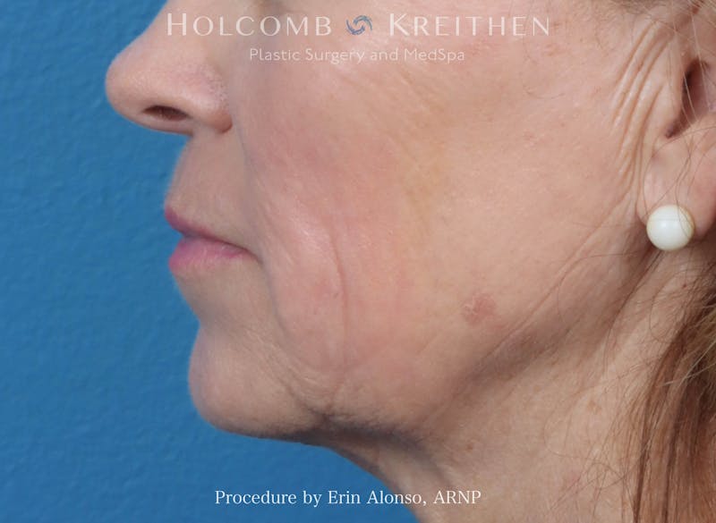 Morpheus  Before & After Gallery - Patient 619845 - Image 6