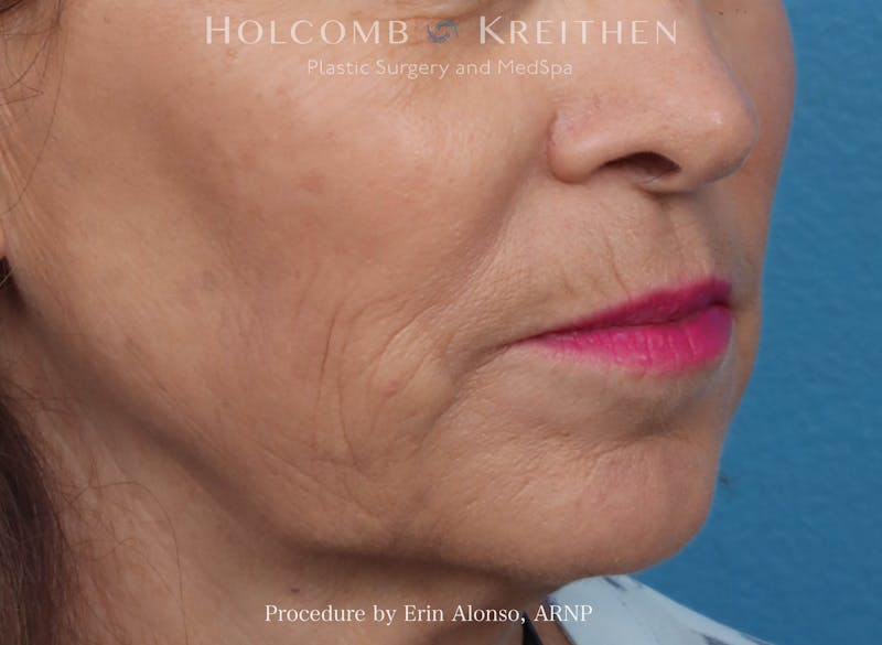 Morpheus  Before & After Gallery - Patient 619845 - Image 7