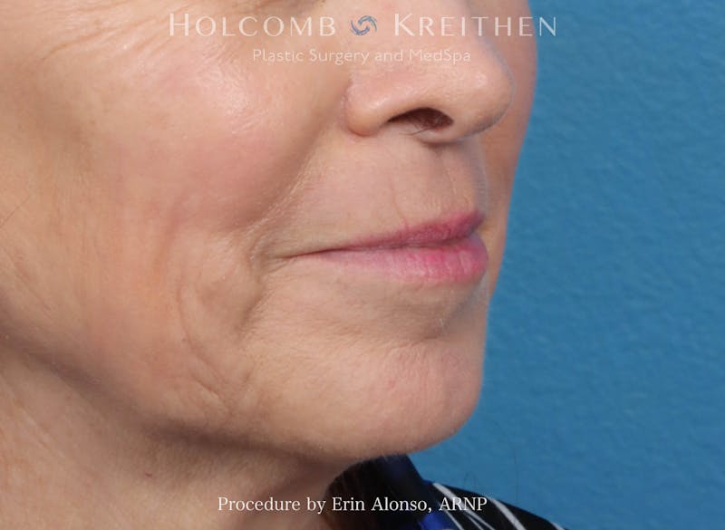 Morpheus  Before & After Gallery - Patient 619845 - Image 8