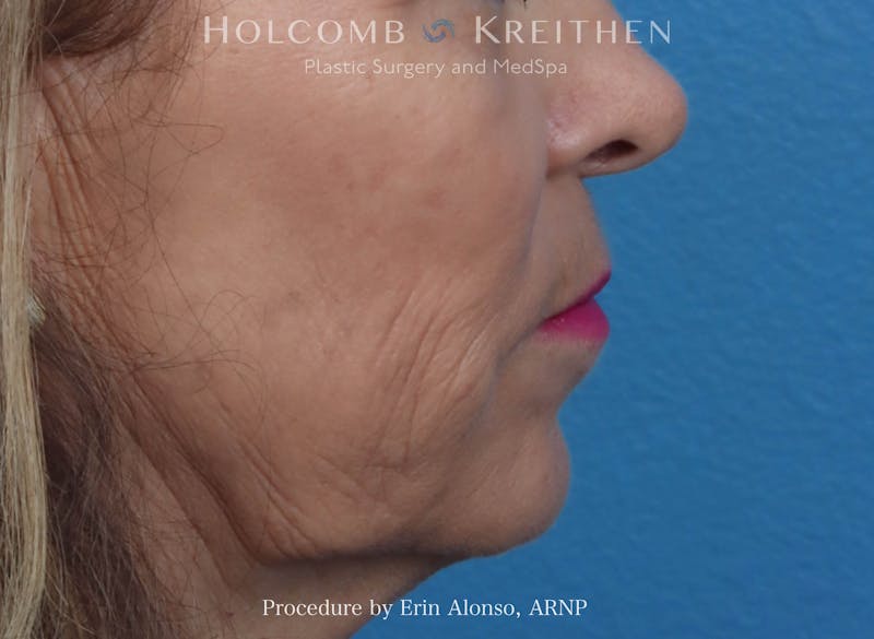 Morpheus  Before & After Gallery - Patient 619845 - Image 9
