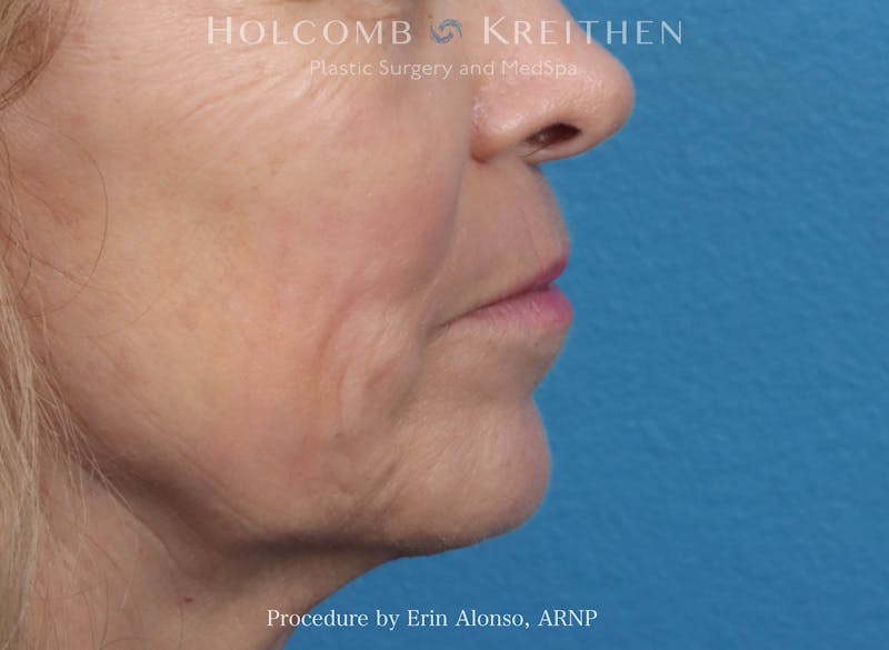 Morpheus  Before & After Gallery - Patient 619845 - Image 10