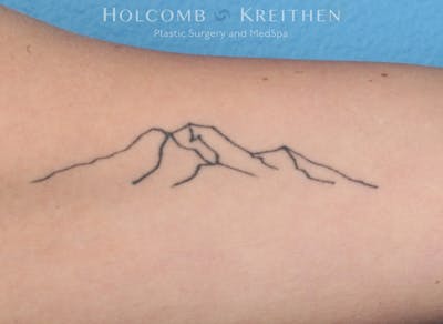Tattoo Removal Before & After Gallery - Patient 300444 - Image 1