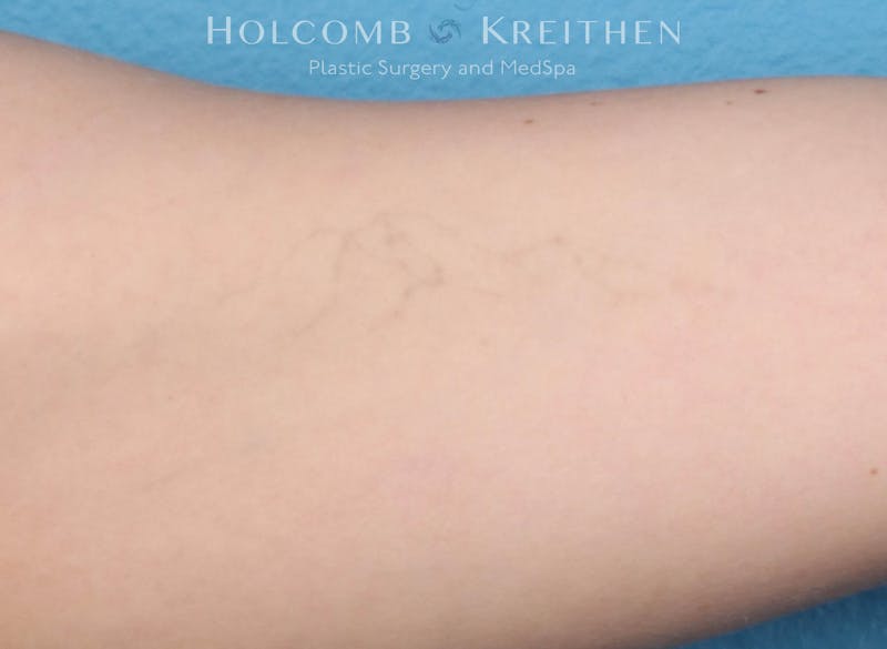 Tattoo Removal Before & After Gallery - Patient 300444 - Image 2