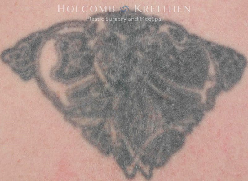 Tattoo Removal Before & After Gallery - Patient 173442 - Image 1
