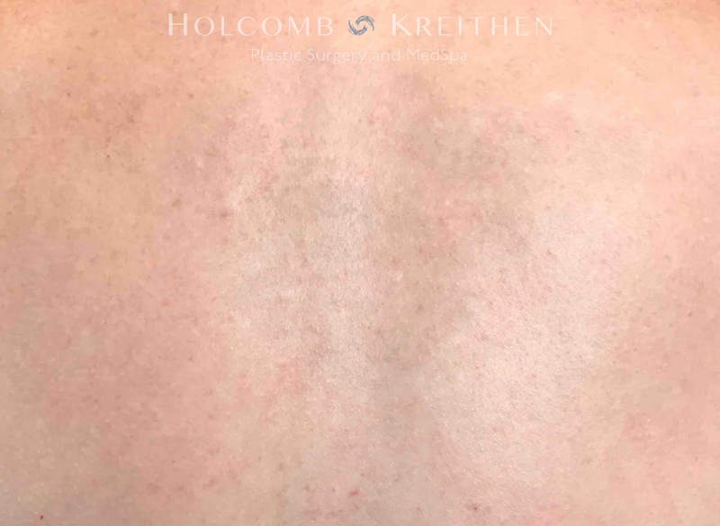 Tattoo Removal Before & After Gallery - Patient 173442 - Image 2