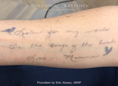 Tattoo Removal Before & After Gallery - Patient 235274 - Image 1