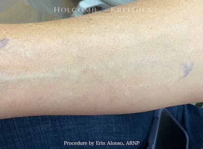 Tattoo Removal Before & After Gallery - Patient 235274 - Image 2