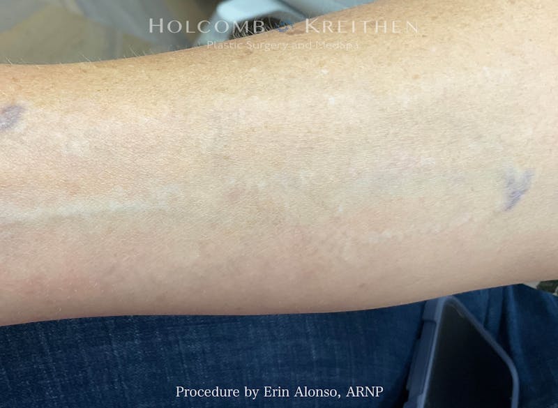 Tattoo Removal Before & After Gallery - Patient 235274 - Image 2