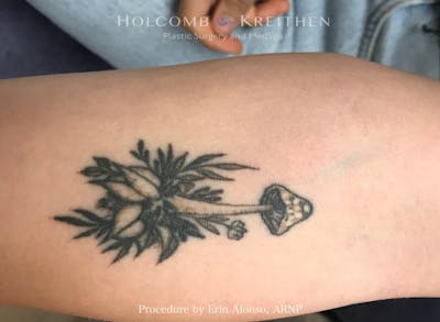 Tattoo Removal Before & After Gallery - Patient 336060 - Image 1