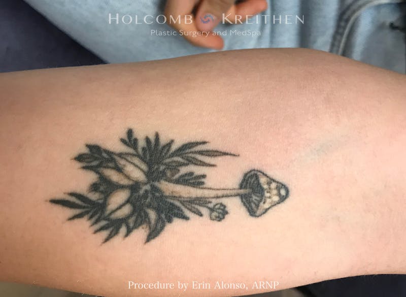 Tattoo Removal Before & After Gallery - Patient 336060 - Image 1